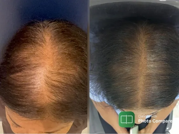 Antes e depois transplante capilar FUE - Paciente 2