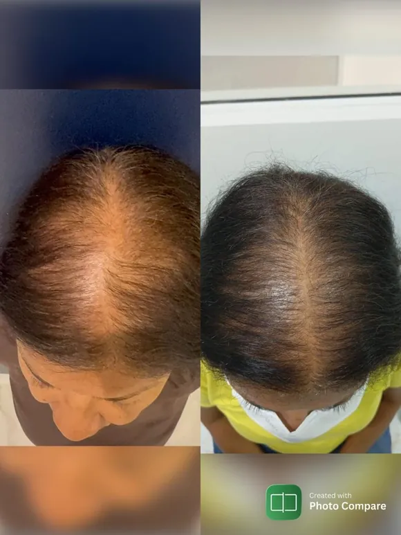 Antes e depois transplante capilar FUE - Paciente 3