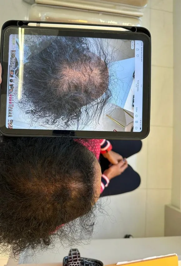 Antes e depois transplante capilar FUE - Paciente 6